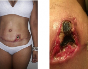 Fisioterapia Dermatofuncional
