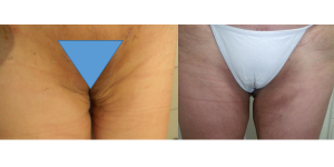 Fisioterapia Dermatofuncional