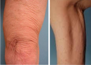 Fisioterapia Dermatofuncional