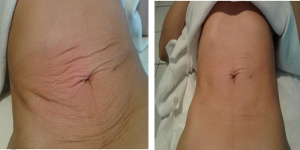 Fisioterapia Dermatofuncional