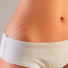 Flacidez de Rostro y Cuerpo
